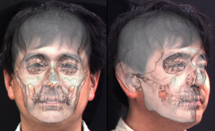 Superimposition image of a skull and facial photo.